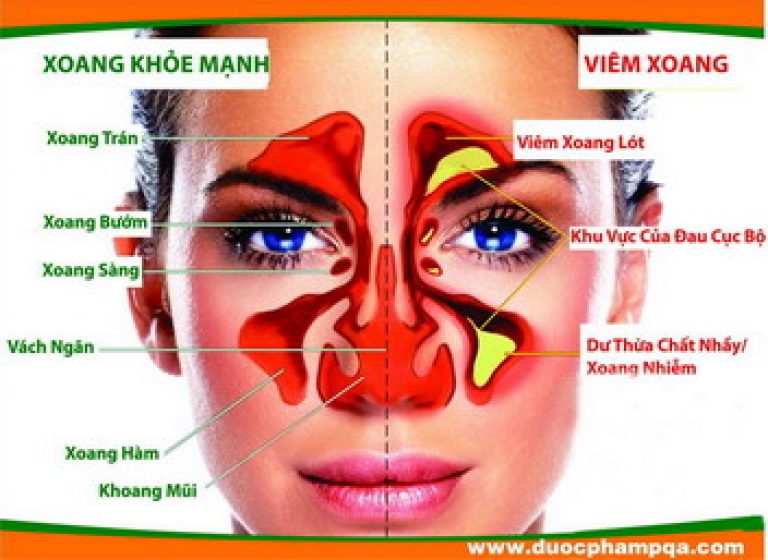 Biến chứng nguy hiểm của bệnh viêm xoang