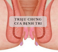 trieu-chung-cua-benh-tri-200x180.png